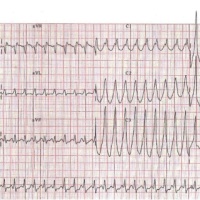 ECG: Taquicardia supraventricular con conducción aberrada, QRS ancho, por vía accesoria: WPW