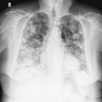 Caso 156 (2ª): Metástasis pulmonares; RX: "suelta de globos"