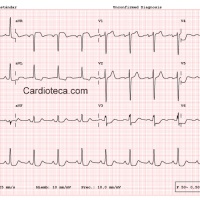 CASO 165: SCASEST - ANGINA INESTABLE