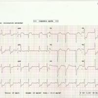 CASO 196: Dolor precordial, ECG descenso generalizado de ST