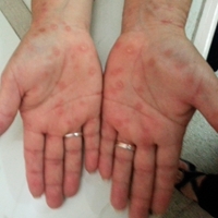CASO 236: Fiebre, hepatitis y lesiones en palmas de las manos
