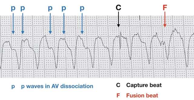 ECG-features-of-VT-AV-dissociation-capture-beat-fusion-beat